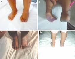 It is possible that club foot shows no physical symptoms and still is present in a patient. Management Of Idiopathic Clubfoot By Ponseti Technique In Children Presenting After One Year Of Age Sciencedirect