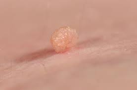 Thrombosed hemorrhoid skin tag removal. Skin Tag Removal Why You Shouldn T Diy Health Essentials From Cleveland Clinic