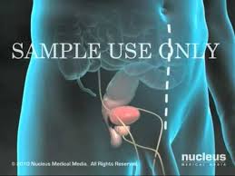 Prostate Gland Surgery Radical Prostatectomy Youtube