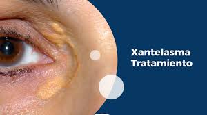 Image result for xantelasma