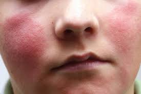 Image result for red rash face