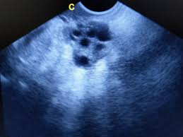 Diet and nutrition in polycystic ovary syndrome (pcos): New Screening Cut Off For Polycystic Ovaries May Exclude Patients From Accurate Pcos Diagnosis