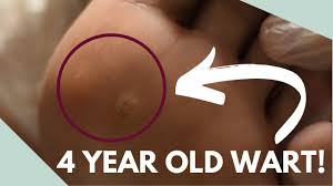 We've been using dr scholls clearaway pads for about a month and from the first application they progressed very very quickly. How To Get Rid Of A Plantar Wart For Good Youtube