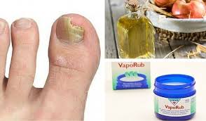 El hongo generalmente aparece como resultado de una higiene deficiente, un sistema inmune débil, diabetes y niveles bajos de ph de la piel. Hongos En Los Pies 3 Remedios Para Eliminarlos Mejor Con Salud