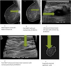 This category is reserved for findings that do not have the classic appearance of malignancy but are sufficiently suspicious to justify a recommendation for biopsy. Defining Radiologic Complete Response Using A Correlation Of Presurgical Ultrasound And Mammographic Localization Findings With Pathological Complete Response Following Neoadjuvant Chemotherapy In Breast Cancer European Journal Of Radiology