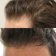 Before And 12 Months After Fue Hair Transplant With Us Beforeandafter Before After Inspo Fue Hairtransf Hair Transplant Fue Hair Transplant Hair Doctor