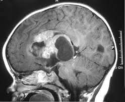How is brain tumor diagnosed in children? Atypical Teratoid Rhabdoid Tumor Wikipedia