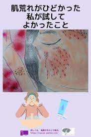 肌荒れがひどかった私が試してよかったこと 肌のこと１ 冷えとり毎日レスキュー女子es 肌荒れ ニキビ 肌荒れ ママへのアドバイス