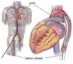 Intra Aortic Balloon Pump I Saw One Of These Removed Today It Was So Cool The Balloon Inflates As The Aorta C Critical Care Nursing Balloon Pump Cardiac Rn