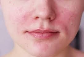 Ba cách nhận biết da nhạy cảm