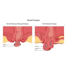 Image result for Rectal prolapse