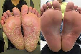 Psoríase é uma doença autoimune de longa duração caracterizada por manchas na pele. Psorioff Psorioff