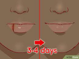 How To Treat A Cut Lip (With Pictures) - Wikihow