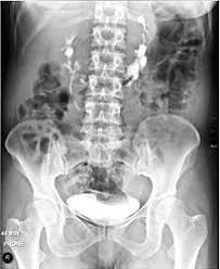 Image result for Intravenous Pyelogram