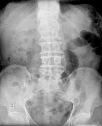 Plain Abdominal Radiograph Demonstrating Two Surgical Clips In The Download Scientific Diagram