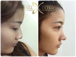 Tip Plasty Photos In Thailand Plastic Surgery Plastic Surgery Photos Clinic