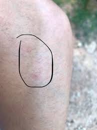 Ignoring the early warning signs and symptoms of any skin … Is This Skin Cancer These Spots Suddenly Appeared I M 24 Years Old Does It Look Like Basal Cell Carcinoma I Don T Have A History Of Skin Cancer In The Family Though I
