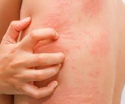 Image result for scabies on humans