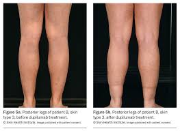 Image result for Atopic Patient