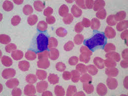 Infectious mononucleosis (mono) is often called the kissing disease. Treating Mononucleosis Why The Mystery