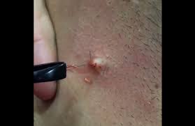 You can get deep ingrowing hairs in the pubic area, on it not common to have ingrown hairs on the neck. Ingrown Hair How To Deal With Ingrown Hairs On Neck