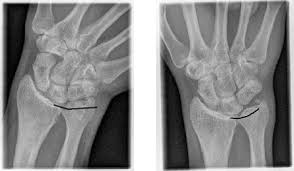 Ulnar Impaction Syndrome: A Case Series Investigating The Appropriate  Diagnosis, Management, And Post-Operative Considerations