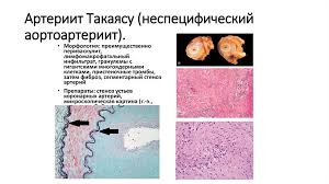 Панваскулит с резким сужением просвета сосуда; Revmaticheskie Bolezni Online Presentation