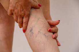 6 Ejercicios Para Prevenir O Reducir Las Varices Todos Son De Bajo Impacto Y No Te Agotaran Estilo De Vida Bienestar Univision