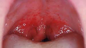 Purpura spots larger than 1 cm (centimeter) are called ecchymoses. Purpura Causes Diagnosis Treatment And Pictures