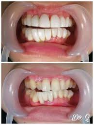 Последние твиты от veneer gigi ori (@safwanmajid). Fake Dentist Semakin Terbuka Tawarkan Perkhidmatan Fake Veneer The Malaya Post