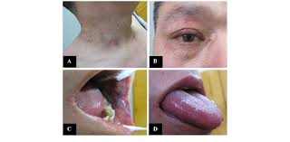 Hypodense lesions suggestive of multiple myeloma were observed in the jaws of 73.8 conclusions: Multiple Myeloma Associated Skin Light Chain Amyloidosis A Case Of Misdiagnosis