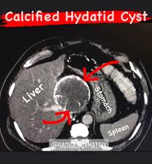 Contains multiple internal daughter cysts of lower density than mother cyst (exocyst). Dr Amer Hydatid Cysts Result From Infection By The Echinococcus Tapeworm Species And Can Result In Cyst Formation Anywhere In The Body Pathology There Are Two Main Species Of The Echinococcus Tapeworm