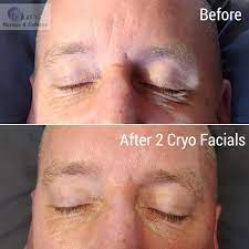 Cryo T Shock Facial Under Eye Puffiness Cryo Facial Puffy Eyes
