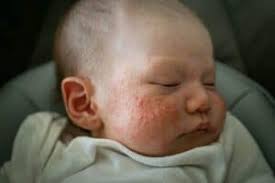 Baby Acne: What Parents Need To Know ...
