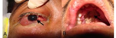 Hifas anchas, tipicamente aseptadasa diferencia de las de aspergillus. Tratamiento Exitoso De Mucormicosis Rino Orbito Cerebral En Un Paciente Trasplantado Renal Nefrologia
