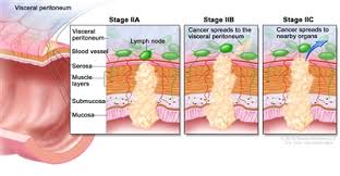 However, this cancer can be difficult to treat in younger children because oftentimes they do not show any signs of having colon cancer until the tumors have progressed into the more dangerous stages. Colon Cancer Treatment Pdq Treatment Patient Information Nci Cs Mott Children S Hospital Michigan Medicine