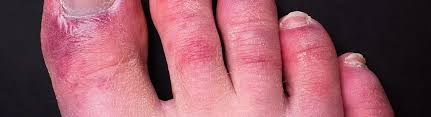 Image result for Chilblains