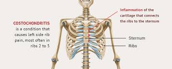 Pain under the rib cage on the left side can be caused by a pulled muscle or irritable bowel. Getting To The Bottom Of Rib Cage Pain Nydnrehab Com