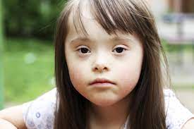 Esta trisomía es la alteración genética más común en los seres humanos y se genera de manera espontánea (sin causa aparente). Sindrome De Down Causas Tipos Y Caracteristicas