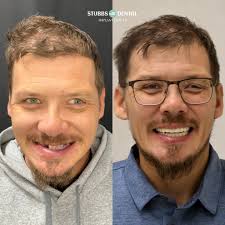 Stubbs Dental Implant...