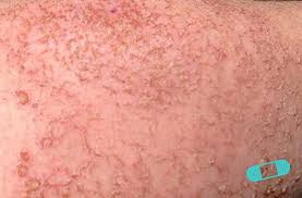 Image result for dermatitis contacta toxica