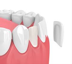 The website does not give statistics for the number of participants that have dental insurance coverage exclusively. Cosmetic Dentist Brownstown Teeth Whitening Porcelain Veneers
