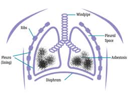 If you have been exposed to asbestos and think you have an asbestos claim, a number. What Is Asbestosis Asbestos Exposure Prolonged Asbestos Exposure National Asbestos Helpline