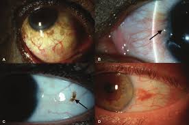 Image result for melanosis sclera