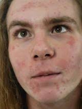 DermaHealer UVB Light Therapy Lamp