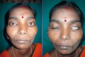 Bell palsy can affect anyone at any age. Bell S Palsy Treatment Tamilnadu Jerush Dental Hospital
