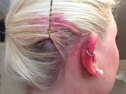 Keloids A Keloid Is A Raised Scar But What Makes It Different From Other Forms Of Scar Tissue Is That It D Earring Hole Infected Ear Piercing Keloid Piercing