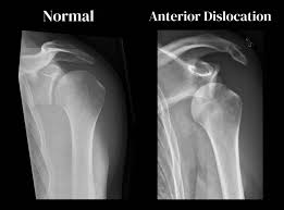 Image result for Chronic Shoulder Dislocation