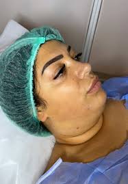 Double Chin Liposuction and Jawline Surgery in Istanbul