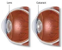  blade free cataract surgery in mumbai
